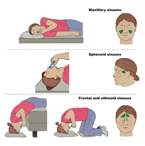 ĐIỀU TRỊ TẠI CHỖ MŨI XOANG CHO TRẺ EM