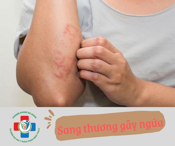 TIÊM CORTICOID TRONG SANG THƯƠNG DA
