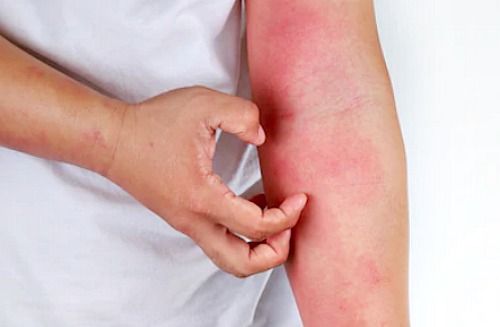 Viêm da Tiếp xúc là gì và hướng điều trị
