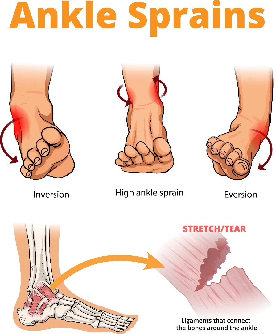 Sơ cứu chấn thương cổ chân: Những sai lầm phổ biến gây ra biến chứng khó lường