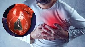 Heart Attack: Symptoms, Diagnosis, Treatment, and Prevention
