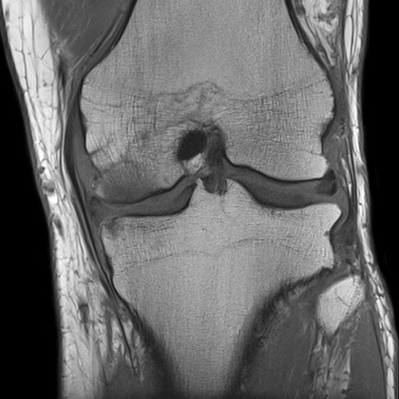 17zza_C20_Knee_T1_TSE_cor_384_G2_bonebrusie_meniscal_tear