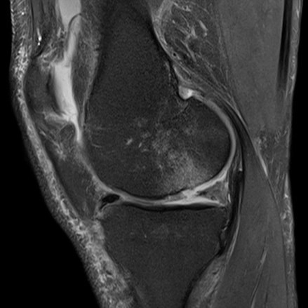 17zzc_C20_Knee_PD_TSE_FatSat_sag_320_G2_bonebruise_meniscal_tear