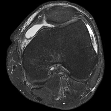 17zzd_C20_Knee_T2_TSE_R_FatSat_tra_384_G2_bonebruise_meniscal_tear