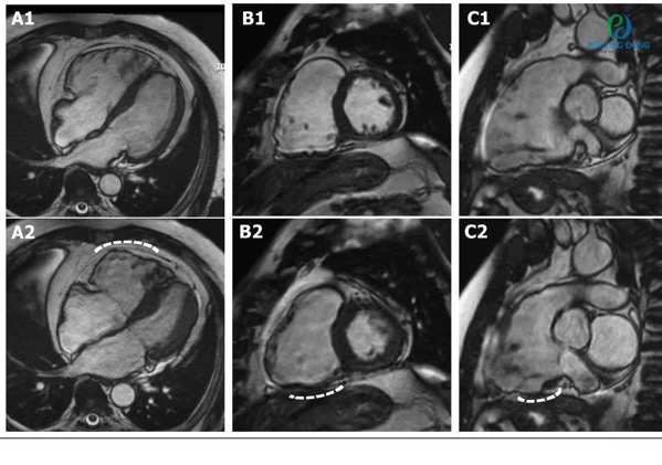 Chụp MRI tim là gì? Kỹ thuật cộng hưởng từ tim có rủi ro nào không?